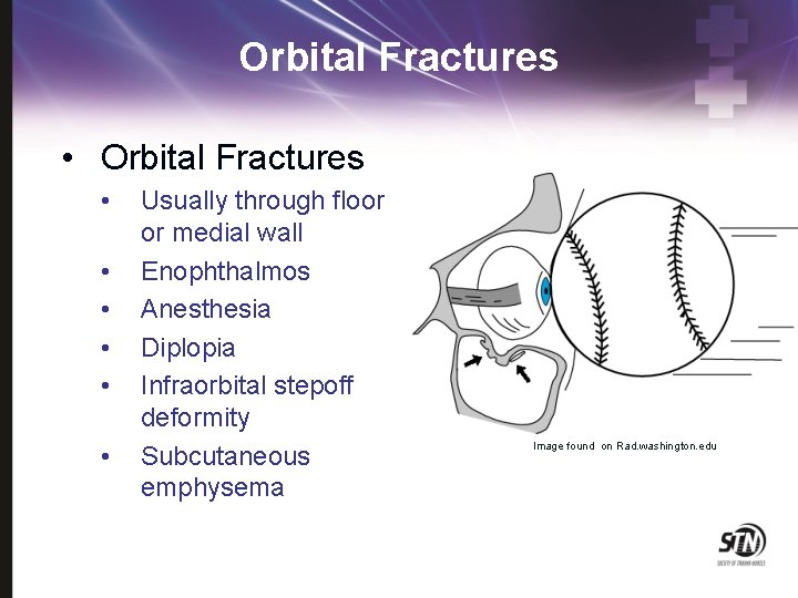 Orbital Fractures • • Usually through floor or medial wall Enophthalmos Anesthesia Diplopia Infraorbital