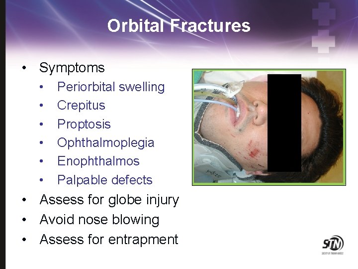 Orbital Fractures • Symptoms • • • Periorbital swelling Crepitus Proptosis Ophthalmoplegia Enophthalmos Palpable
