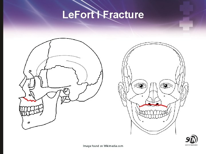 Le. Fort I Fracture Image found on Wikimedia. com 