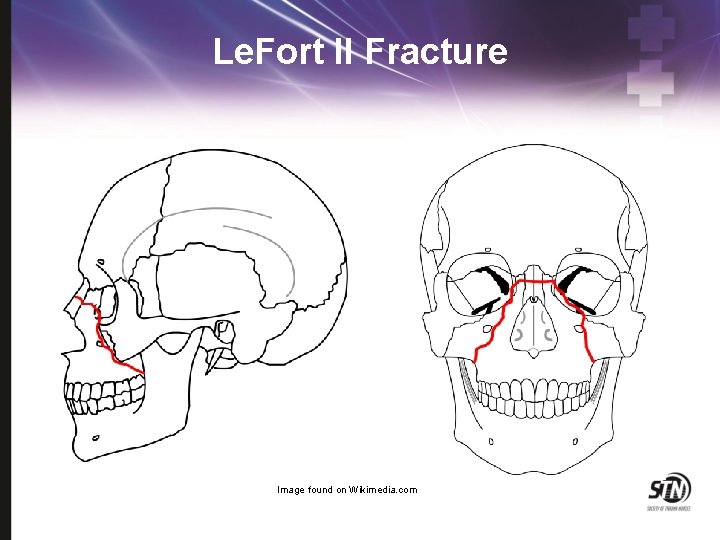 Le. Fort II Fracture Image found on Wikimedia. com 