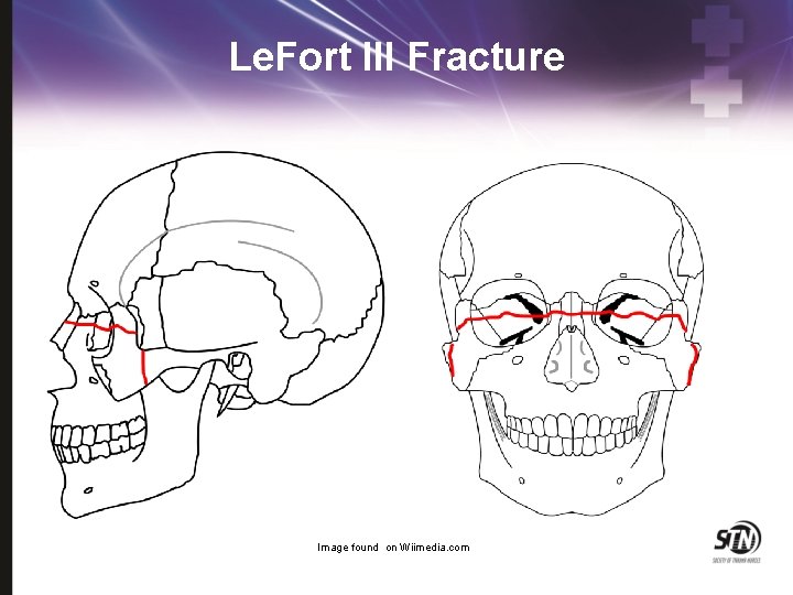 Le. Fort III Fracture Image found on Wiimedia. com 