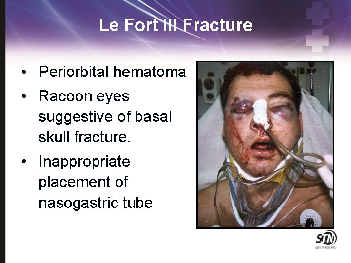 Le Fort III Fracture • Periorbital hematoma • Racoon eyes suggestive of basal skull