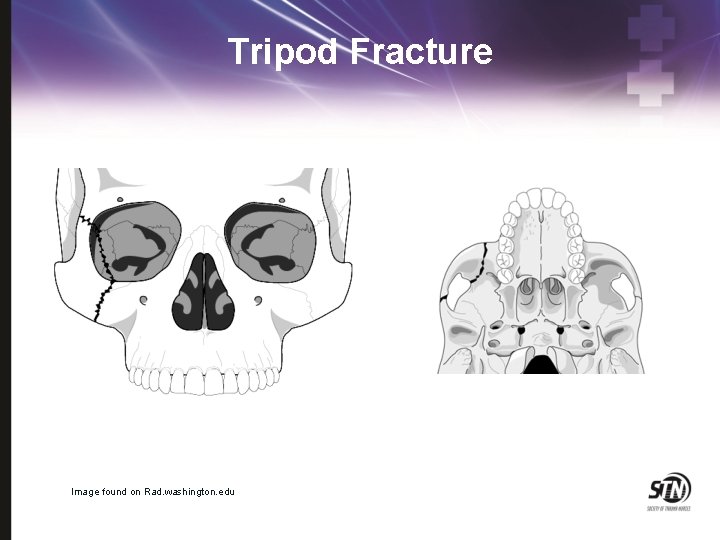 Tripod Fracture Image found on Rad. washington. edu 