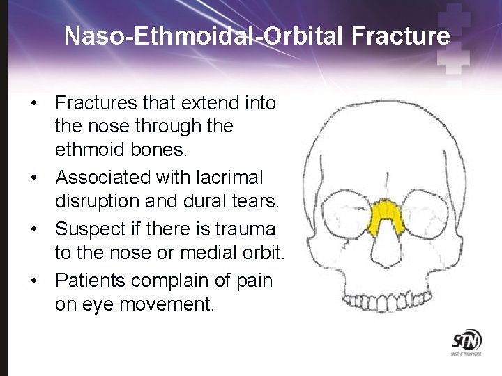 Naso-Ethmoidal-Orbital Fracture • Fractures that extend into the nose through the ethmoid bones. •