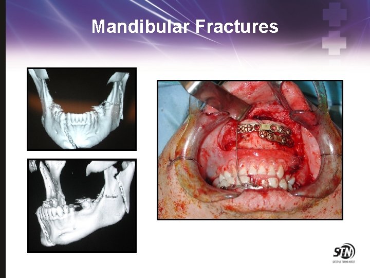 Mandibular Fractures 