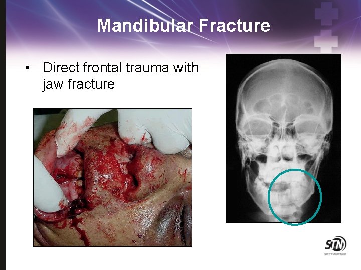 Mandibular Fracture • Direct frontal trauma with jaw fracture 