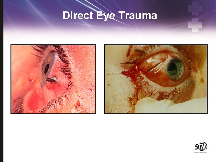 Direct Eye Trauma 