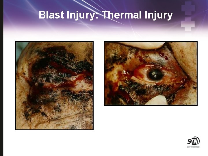 Blast Injury: Thermal Injury 