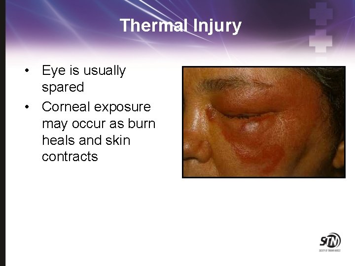 Thermal Injury • Eye is usually spared • Corneal exposure may occur as burn