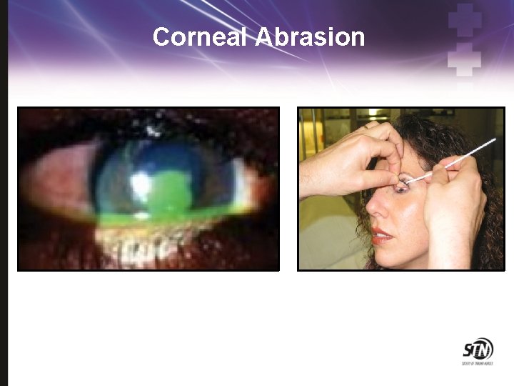 Corneal Abrasion 