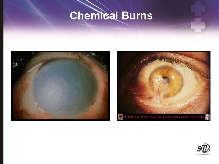 Chemical Burns 