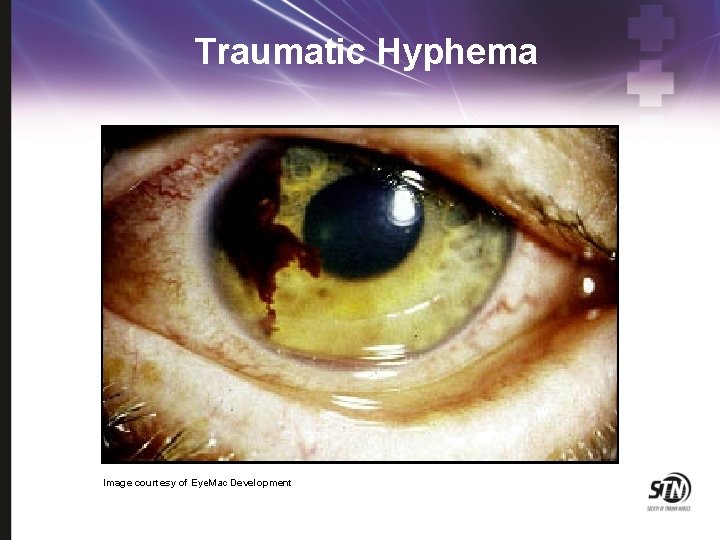 Traumatic Hyphema Image courtesy of Eye. Mac Development 