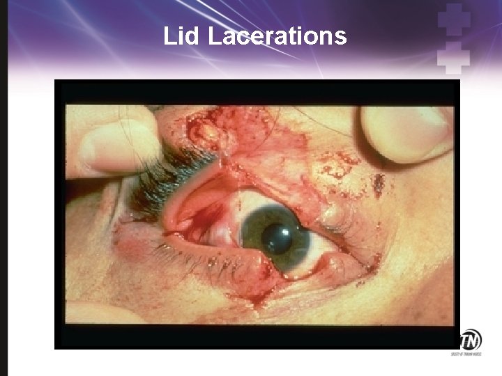 Lid Lacerations 