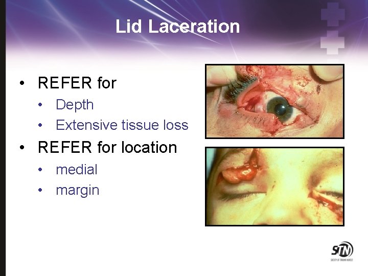 Lid Laceration • REFER for • Depth • Extensive tissue loss • REFER for