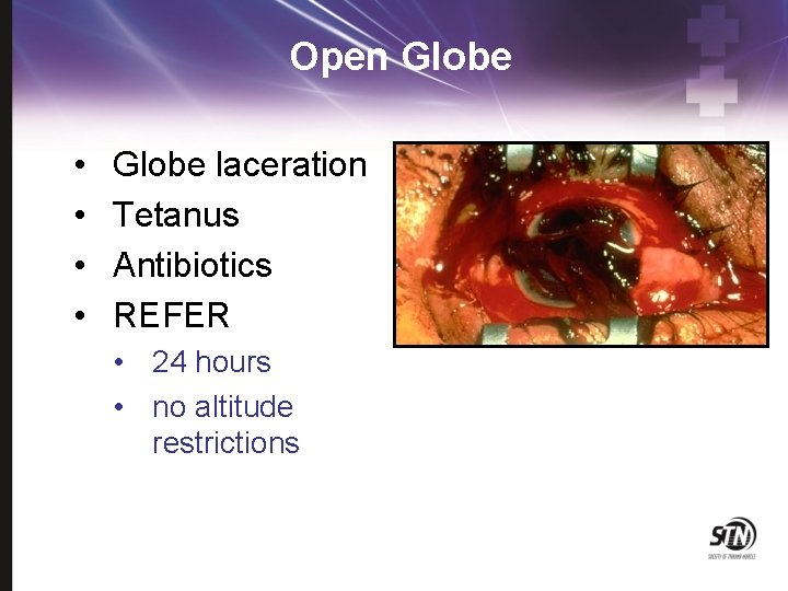 Open Globe • • Globe laceration Tetanus Antibiotics REFER • 24 hours • no