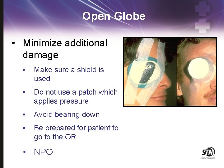 Open Globe • Minimize additional damage • Make sure a shield is used •