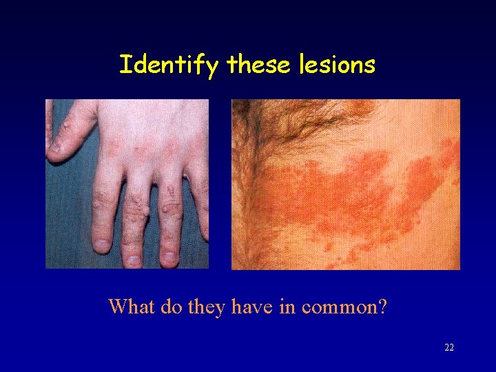 Identify these lesions What do they have in common? 22 