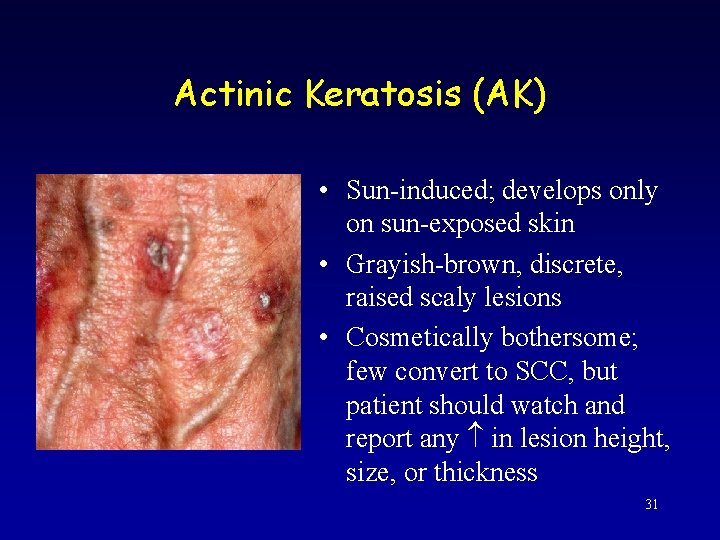 Actinic Keratosis (AK) • Sun-induced; develops only on sun-exposed skin • Grayish-brown, discrete, raised