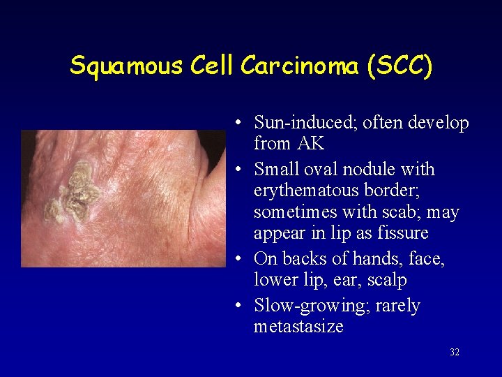 Squamous Cell Carcinoma (SCC) • Sun-induced; often develop from AK • Small oval nodule