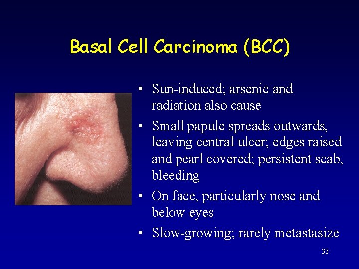 Basal Cell Carcinoma (BCC) • Sun-induced; arsenic and radiation also cause • Small papule