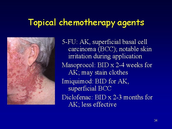 Topical chemotherapy agents 5 -FU: AK, superficial basal cell carcinoma (BCC); notable skin irritation