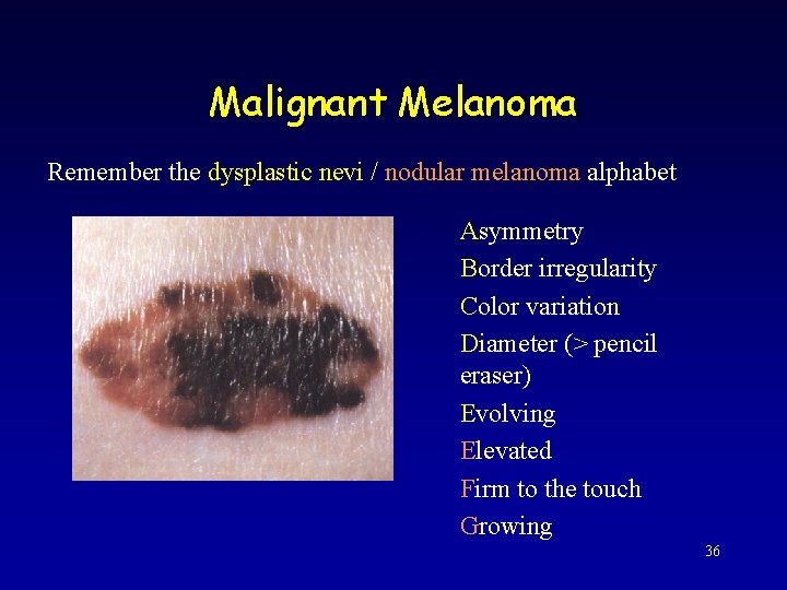 Malignant Melanoma Remember the dysplastic nevi / nodular melanoma alphabet Asymmetry Border irregularity Color
