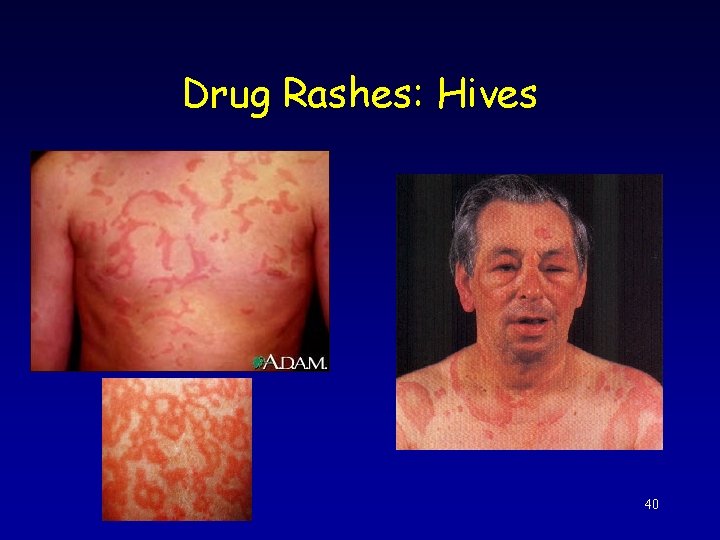 Drug Rashes: Hives 40 