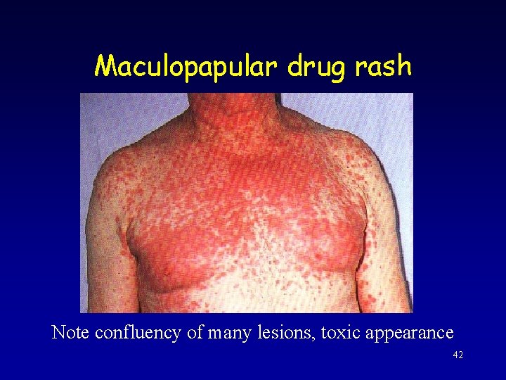 Maculopapular drug rash Note confluency of many lesions, toxic appearance 42 