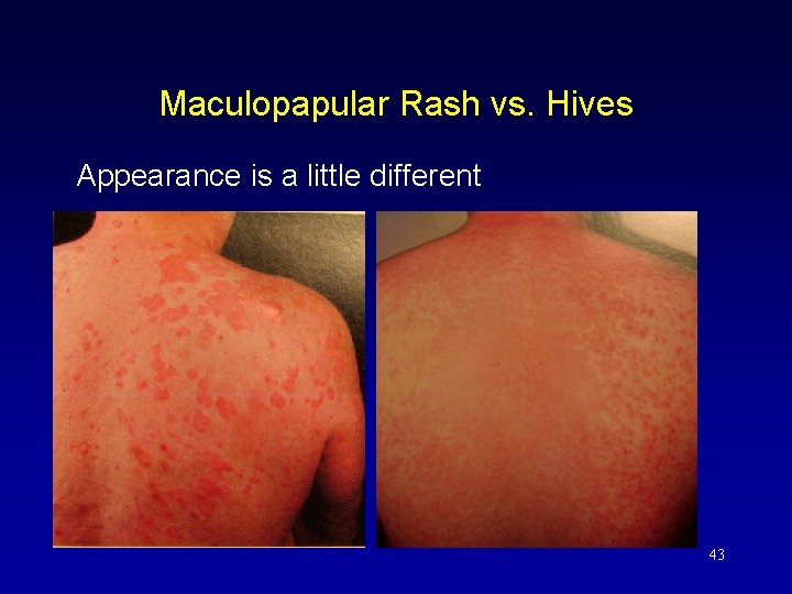 Maculopapular Rash vs. Hives Appearance is a little different 43 