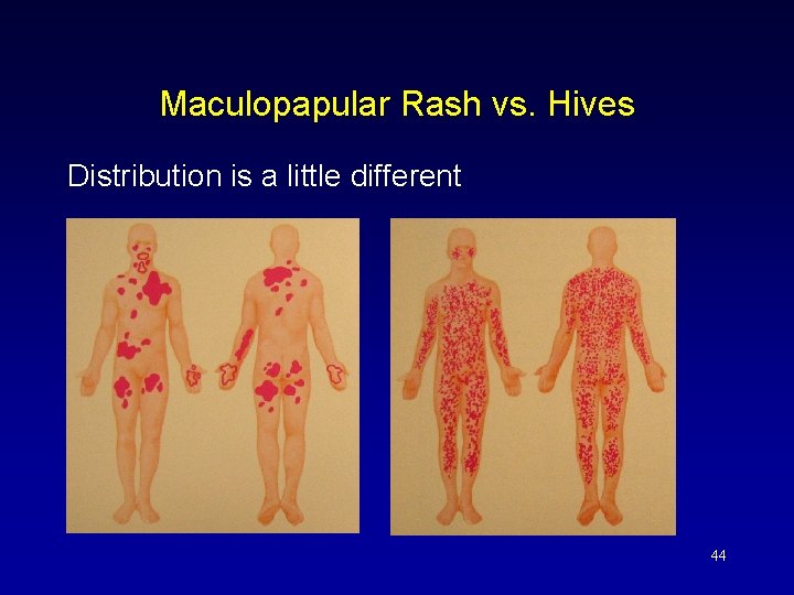 Maculopapular Rash vs. Hives Distribution is a little different 44 