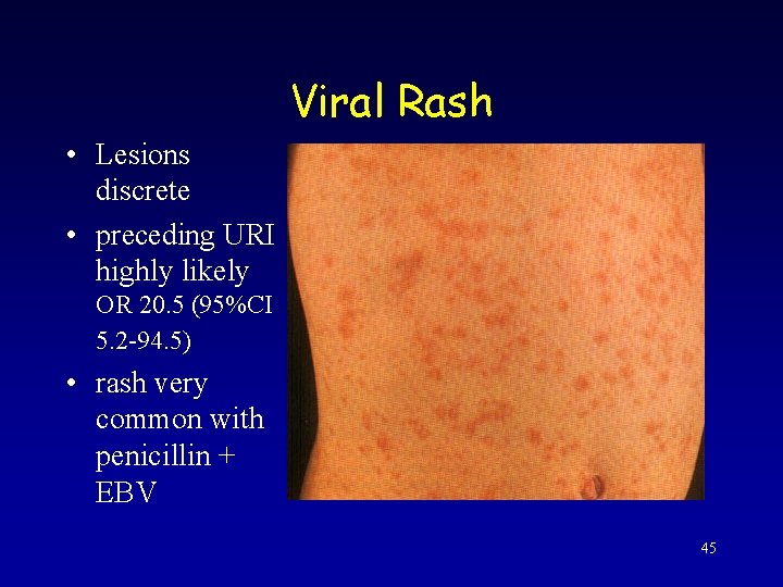 Viral Rash • Lesions discrete • preceding URI highly likely OR 20. 5 (95%CI