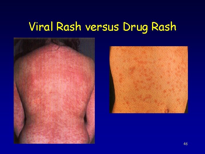 Viral Rash versus Drug Rash 46 