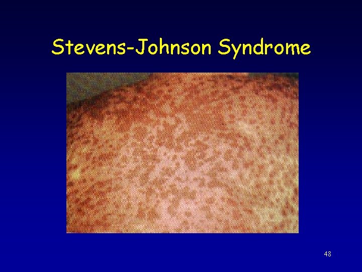 Stevens-Johnson Syndrome 48 
