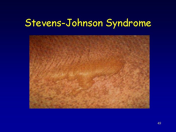 Stevens-Johnson Syndrome 49 