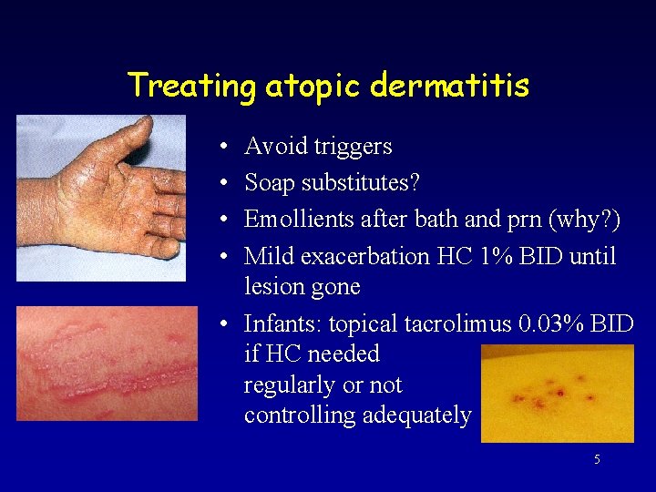 Treating atopic dermatitis • • Avoid triggers Soap substitutes? Emollients after bath and prn