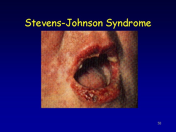 Stevens-Johnson Syndrome 50 