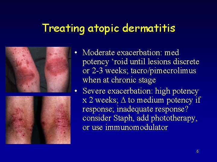 Treating atopic dermatitis • Moderate exacerbation: med potency ‘roid until lesions discrete or 2