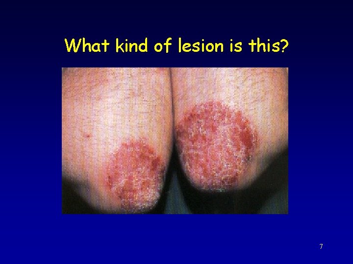 What kind of lesion is this? 7 