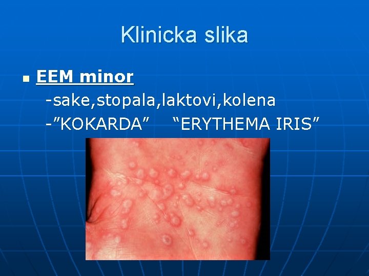 Klinicka slika n EEM minor -sake, stopala, laktovi, kolena -”KOKARDA” “ERYTHEMA IRIS” 