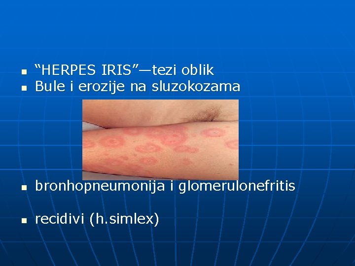 n “HERPES IRIS”—tezi oblik Bule i erozije na sluzokozama n bronhopneumonija i glomerulonefritis n