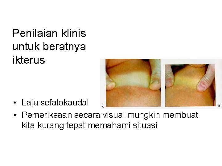 Penilaian klinis untuk beratnya ikterus • Laju sefalokaudal • Pemeriksaan secara visual mungkin membuat