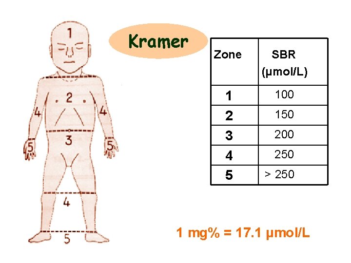 Kramer Zone SBR (µmol/L) 1 2 3 4 5 100 150 200 250 >