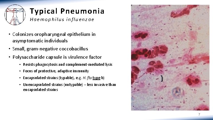 Typical Pneumonia Haemophilus influenzae • Colonizes oropharyngeal epithelium in asymptomatic individuals • Small, gram-negative