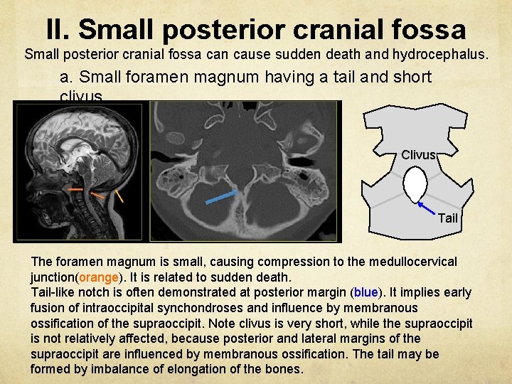 II. Small posterior cranial fossa can cause sudden death and hydrocephalus. a. Small foramen