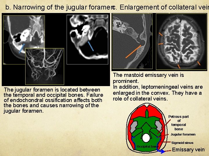 b. Narrowing of the jugular foramenc. Enlargement of collateral vein The jugular foramen is