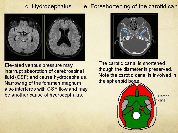 d. Hydrocephalus e. Foreshortening of the carotid cana Elevated venous pressure may interrupt absorption