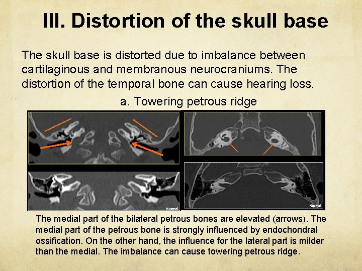 III. Distortion of the skull base The skull base is distorted due to imbalance