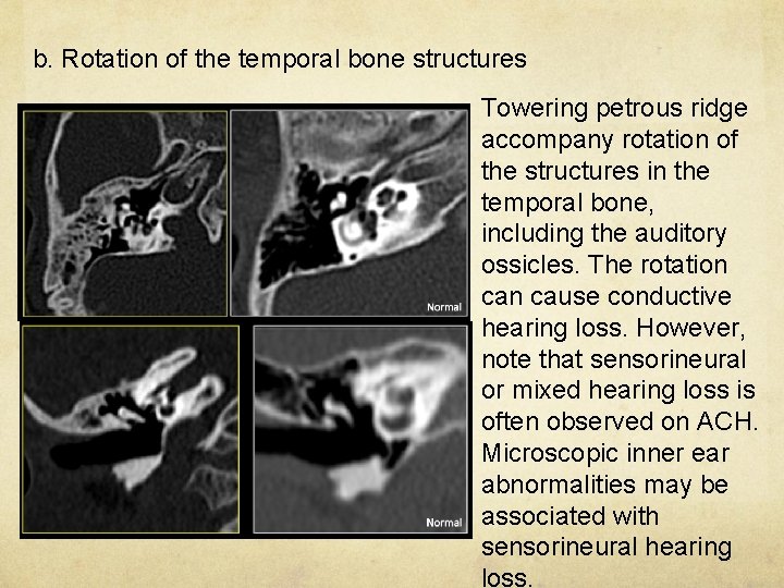 b. Rotation of the temporal bone structures Towering petrous ridge accompany rotation of the