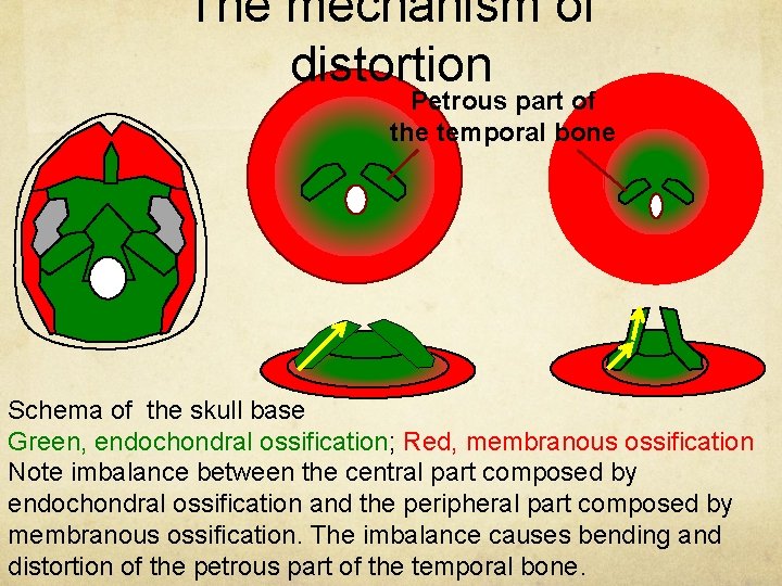 The mechanism of distortion Petrous part of the temporal bone Schema of the skull