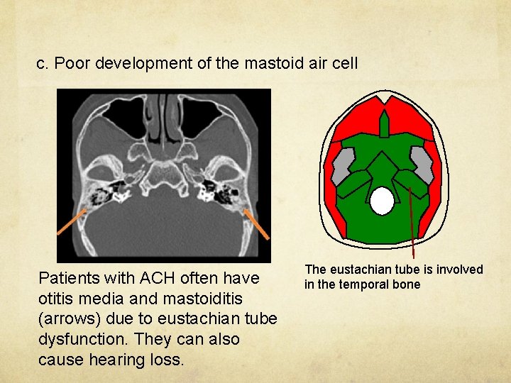 c. Poor development of the mastoid air cell Patients with ACH often have otitis